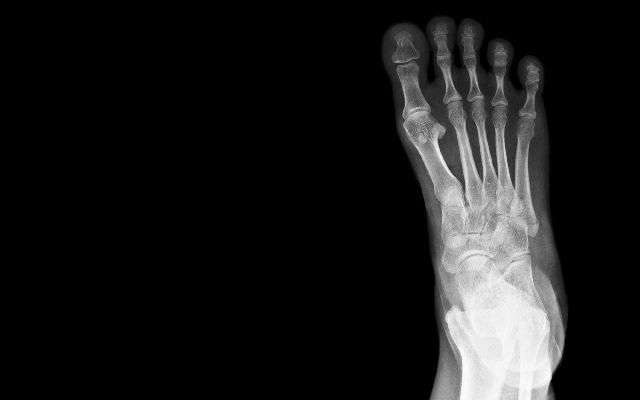 How to Identify, Treat and Prevent a Metatarsal Stress...